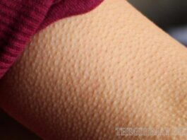 Những điềm báo khi nổi gai ốc trên da