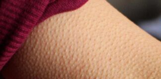 Những điềm báo khi nổi gai ốc trên da