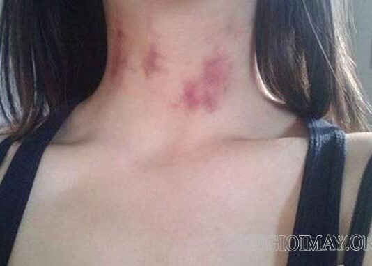 Dấu hickey có thể gây đột quỵ